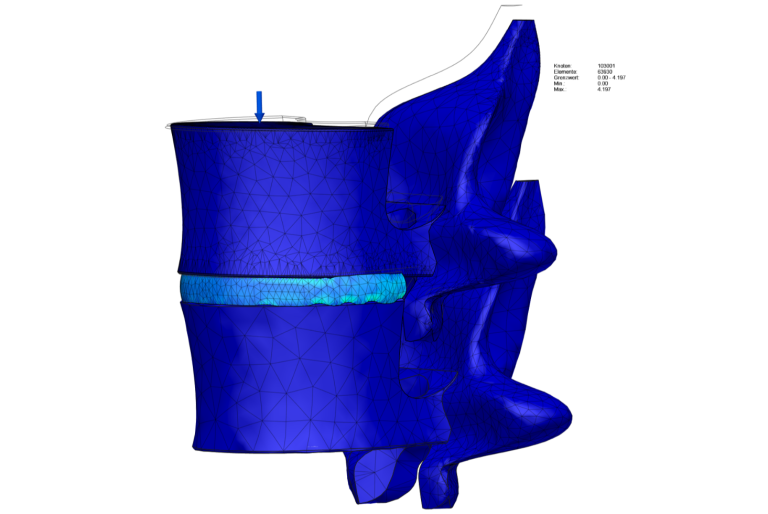 Finite-Elemente-Simulation (FEM) einer Wirbelsäule zur Analyse der Lastverteilung und Spannungen für die Entwicklung von Prothesen
